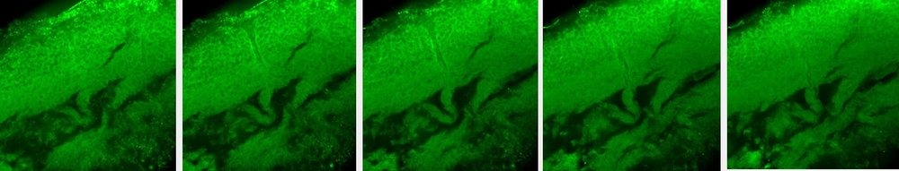 Perimortem injured brain stained with S100b antibody