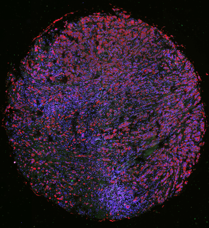 Breast Cancer Multiplex Whole Image