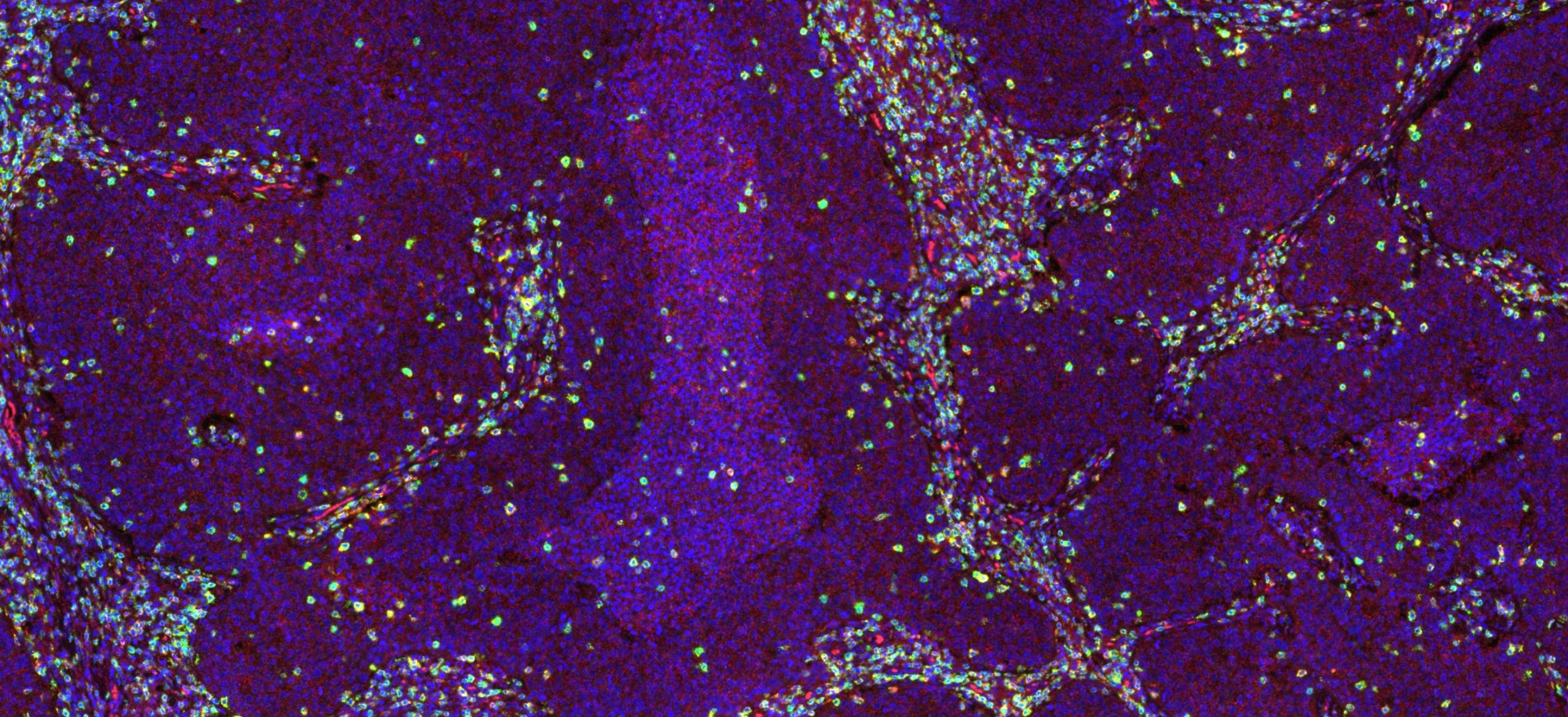 Lung Cancer Multiplex Image