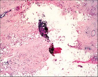 Poorly Fixed Sample Showing Tissue Loss and Degradation